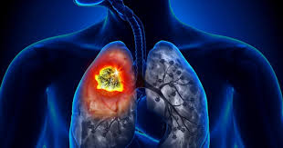 Google trained its AI to predict lung cancer